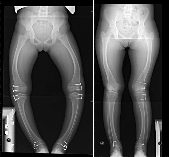 Пластина роста. Болезнь Блаунта рентген. Варусная деформация коленных суставов рентген. Варусная деформация голени рентген. Вальгусная деформация бедра рентген.
