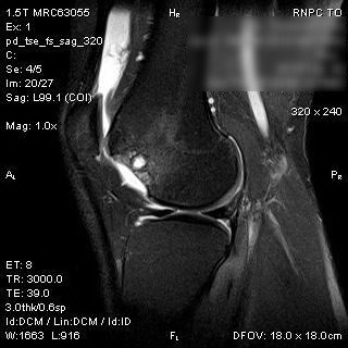 MRI of patient with osteochondritis dissecans before and 2 years after surgery