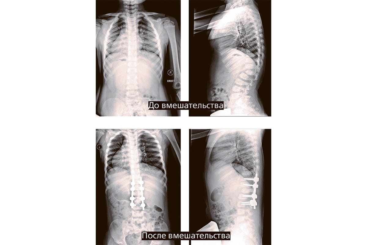 Новые технологии при хирургическом лечении детей с врожденной патологией  позвоночника | ortoped.by